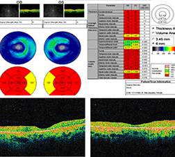 tomografia optica coherente oct cloroquina hidroxicloroquina